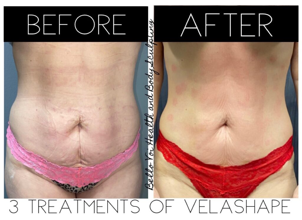 Body Contouring